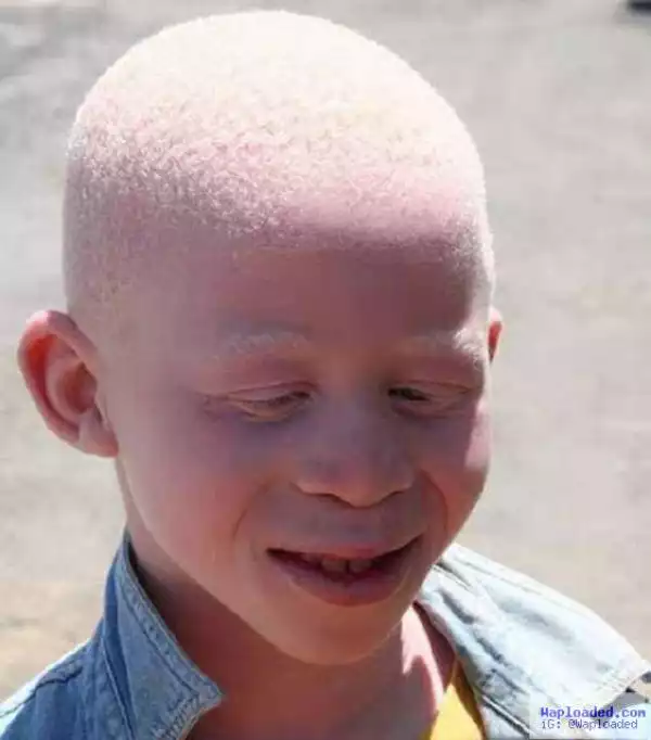See Graphic Photo Of A 9-Year-old Albino Boy That Was Butchered In Malawi For Rituals
